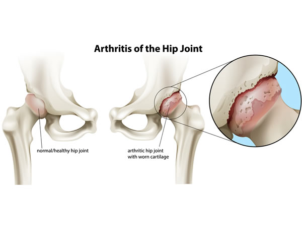 Arthritis of the hip joint