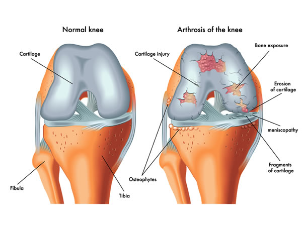 Normal and arthritic knee