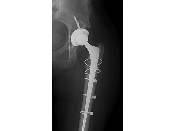 Hip replacement x-ray