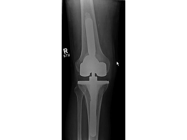 Knee Replacement X-Ray