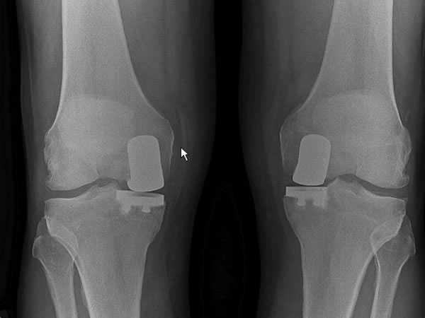 Partial (unicompartmental) knee replacement